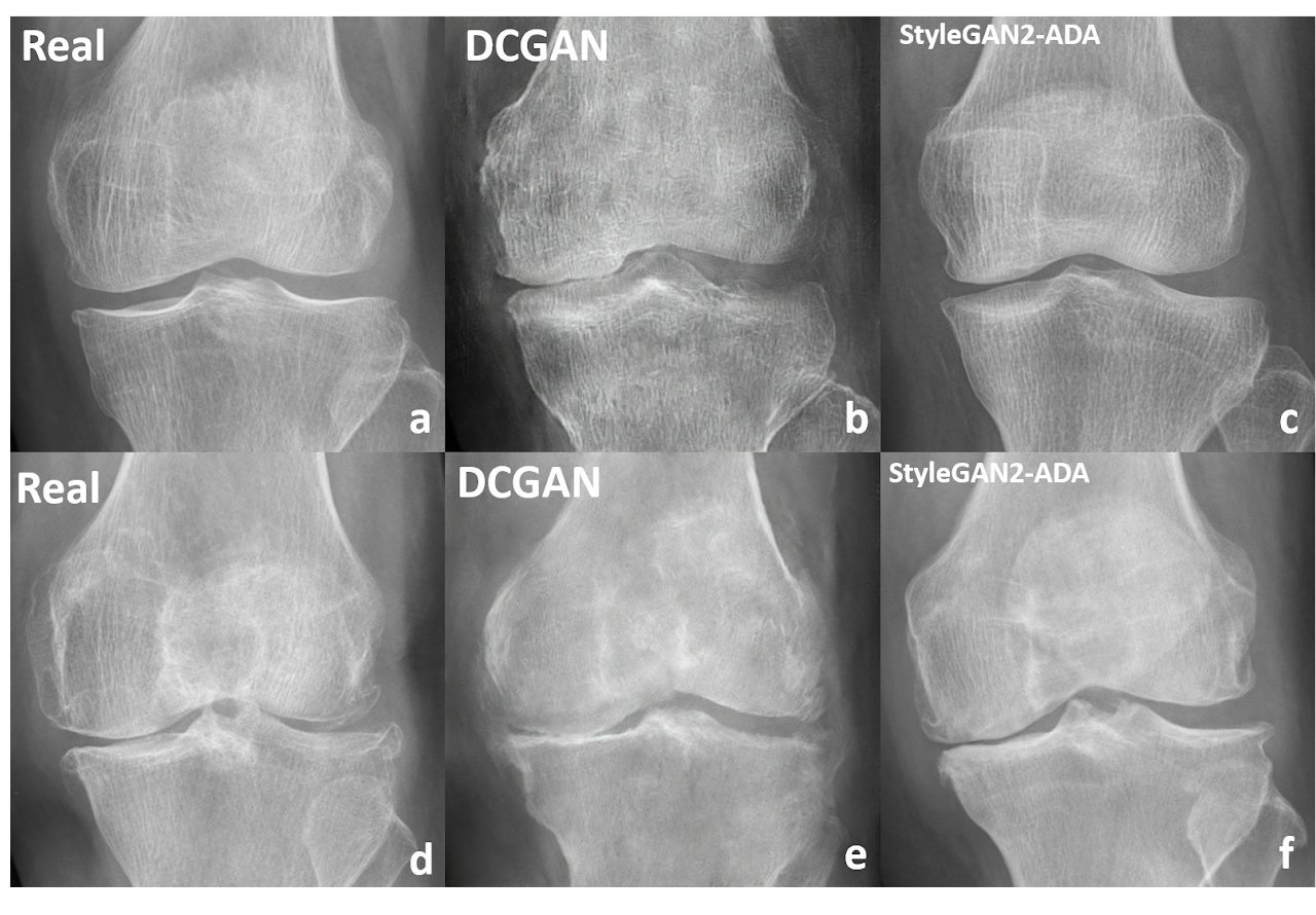Grid comparing real knee radiographs against DCGAN and StyleGAN2-ADA generated images.